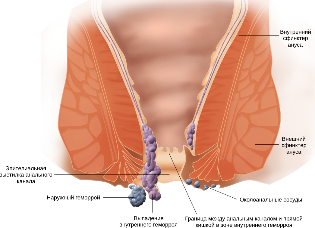 МКБ 10 и геморрой