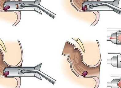 Современное лечение геморроя