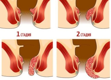 Кто лечит геморрой?