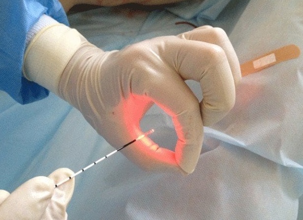 Наркоз при удалении геморроя