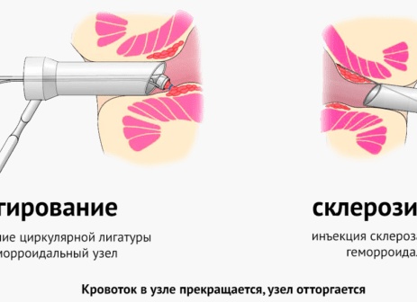 Склеротерапия геморроидального узла