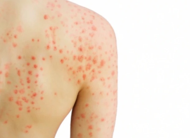 Симптомы и лечение мокнущего геморроя