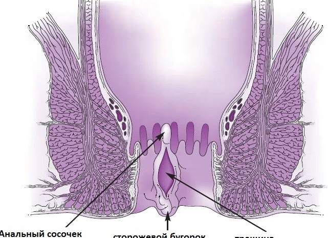 Как лечить геморрой и трещины?