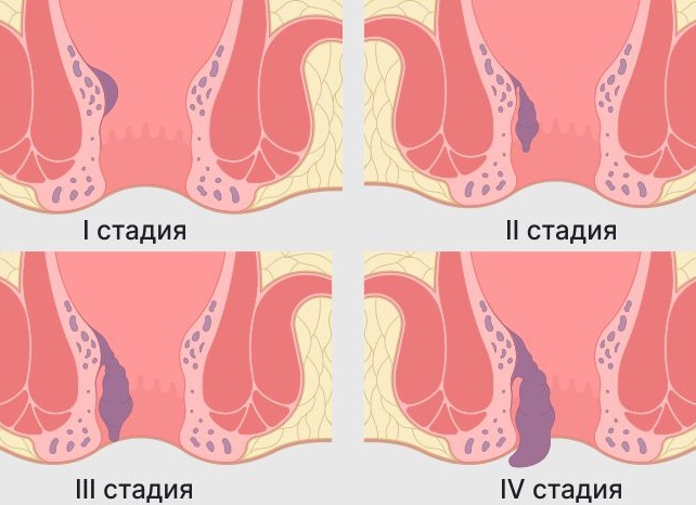 Геморрой и 39 неделя беременности