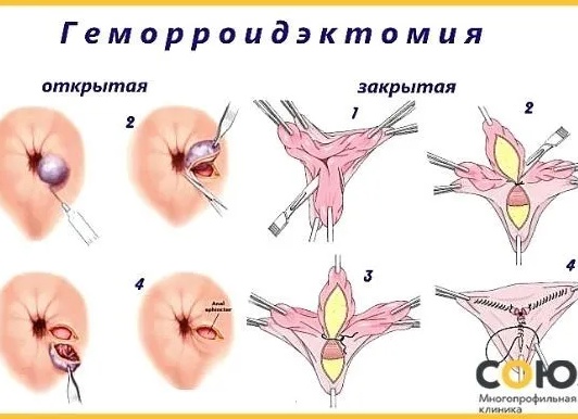 Как избавиться от геморроидальных шишек?
