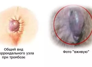 Геморроидальный тромбоз