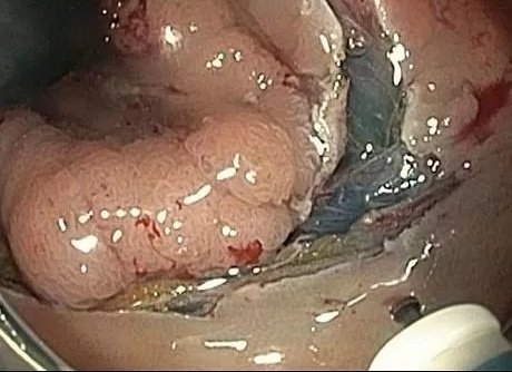 Диета после удаления полипа в прямой кишке