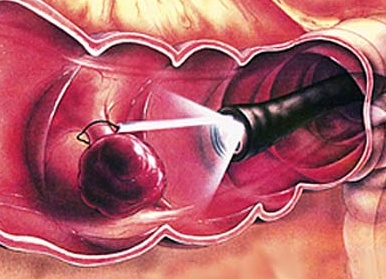 Операции по удалению полипа в прямой кишке