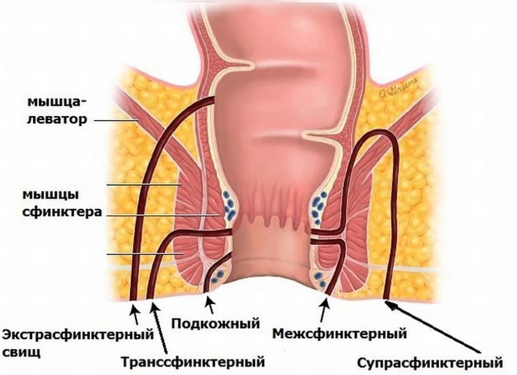Параректальные свищи