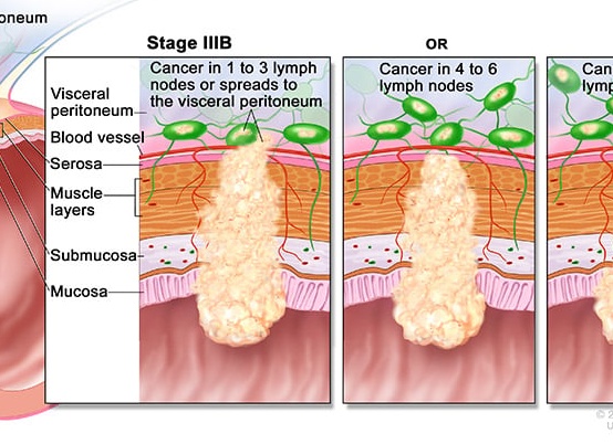 Метастазирующий рак прямой кишки