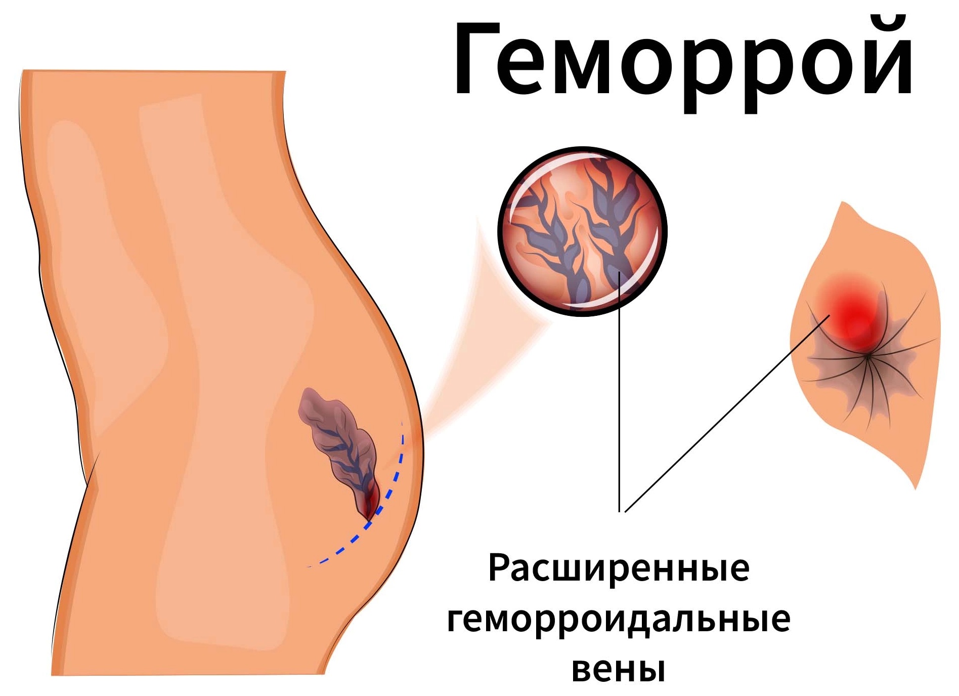 Симптомы и лечение геморроя у женщин