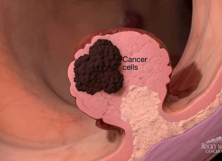 Понимаем различия рака и геморроя и распознаем симптоматику правильно