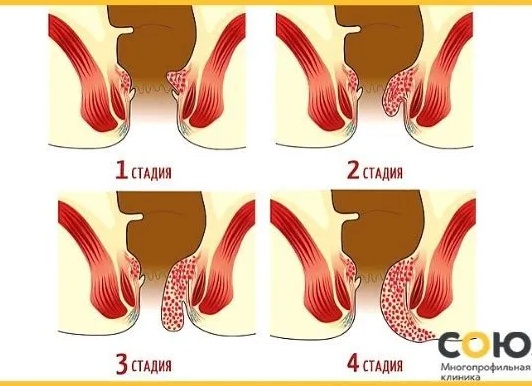 Как убрать геморроидальные узлы?