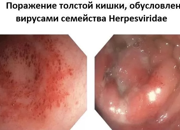 Симптомы и лечение герпетического проктита