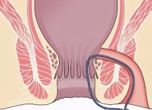 Основные рекомендации по лечению парапроктита в домашних условиях