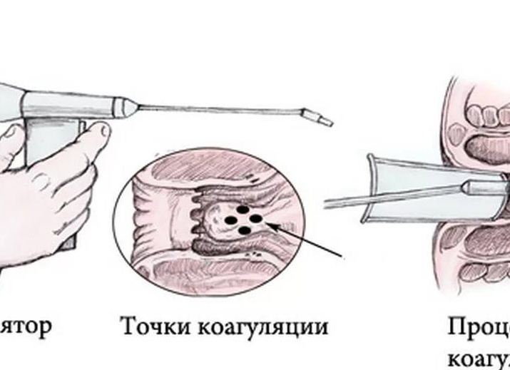 Малоинвазивное удаление геморроя