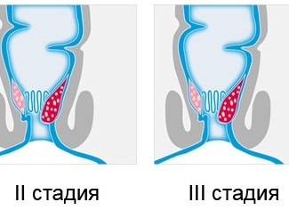 Бахрома при геморрое