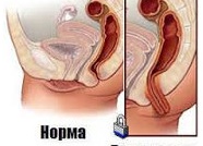 Выпадение прямой кишки у ребенка