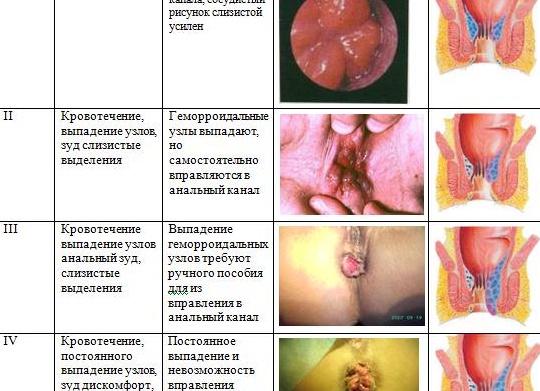 Геморрой от тяжести