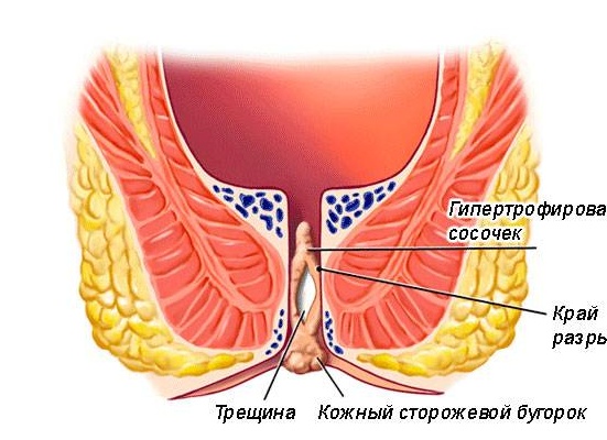 Анальные трещины и ботокс