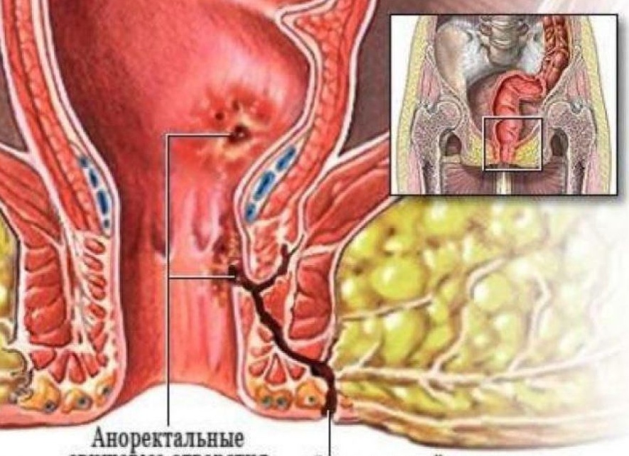 Свищ в прямой кишке
