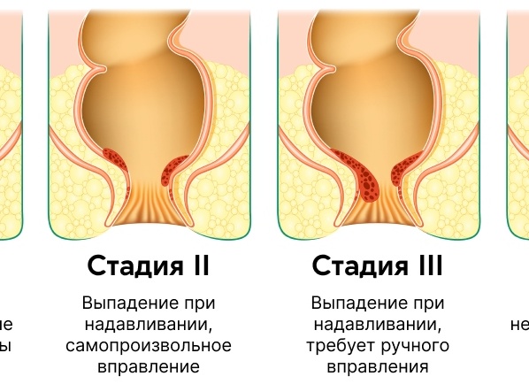Классификация геморроя