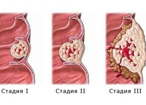 Стадии и лечение плоскоклеточного рака прямой кишки