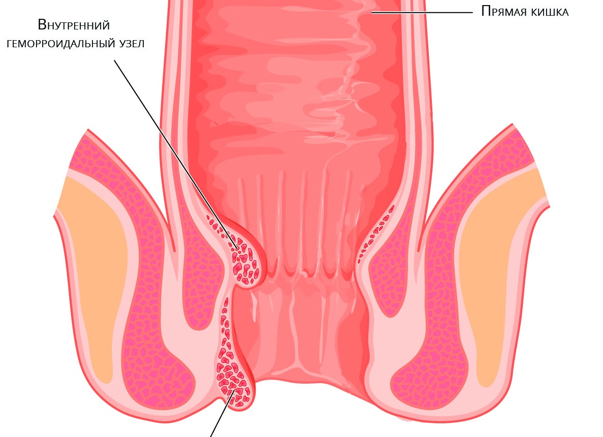 Выпадение узлов при геморрое