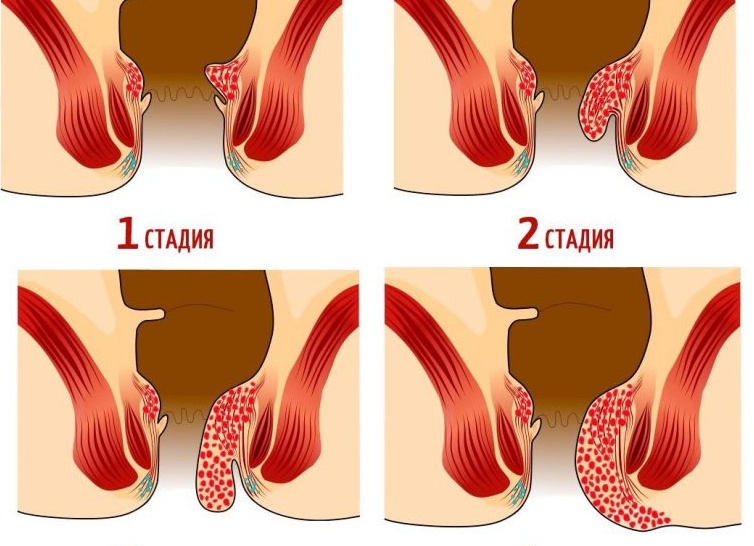 Геморройные шишки