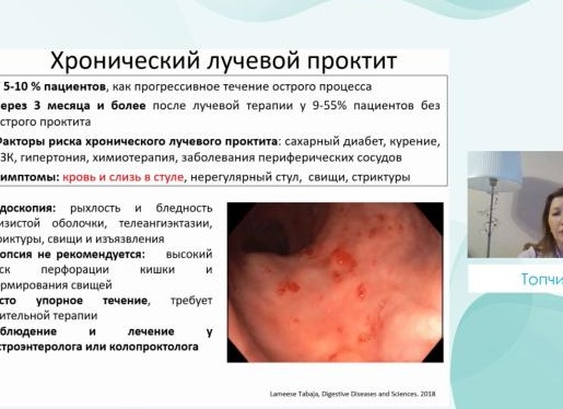 Лечение лучевого проктита