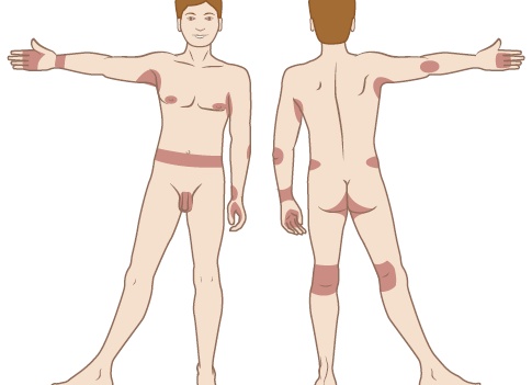 4 компонента «Меновазина» способны одолеть симптоматику геморроя