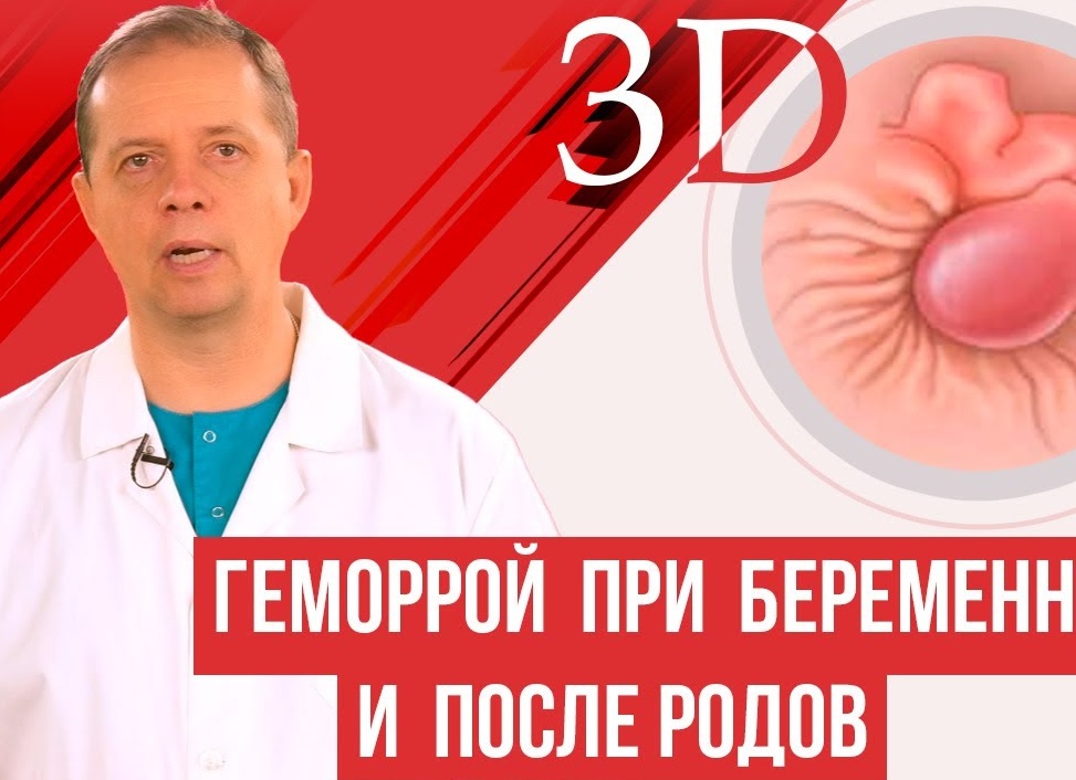 Причины и лечение геморроя после родов