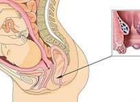 Геморрой на поздних сроках беременности