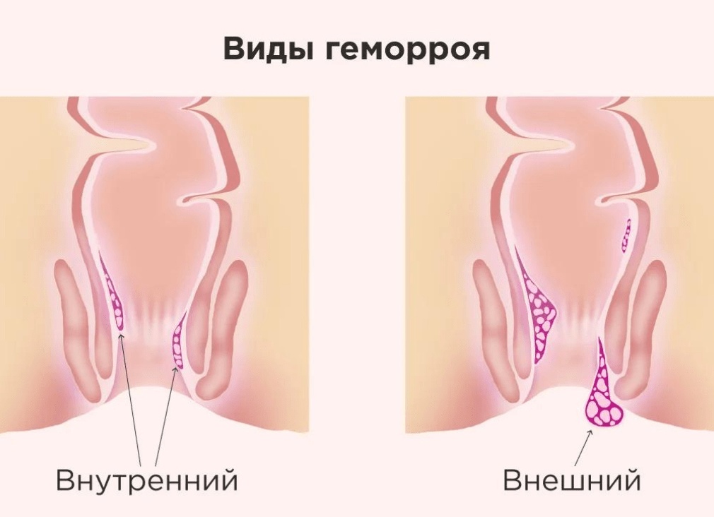 Кровоточит геморрой при беременности