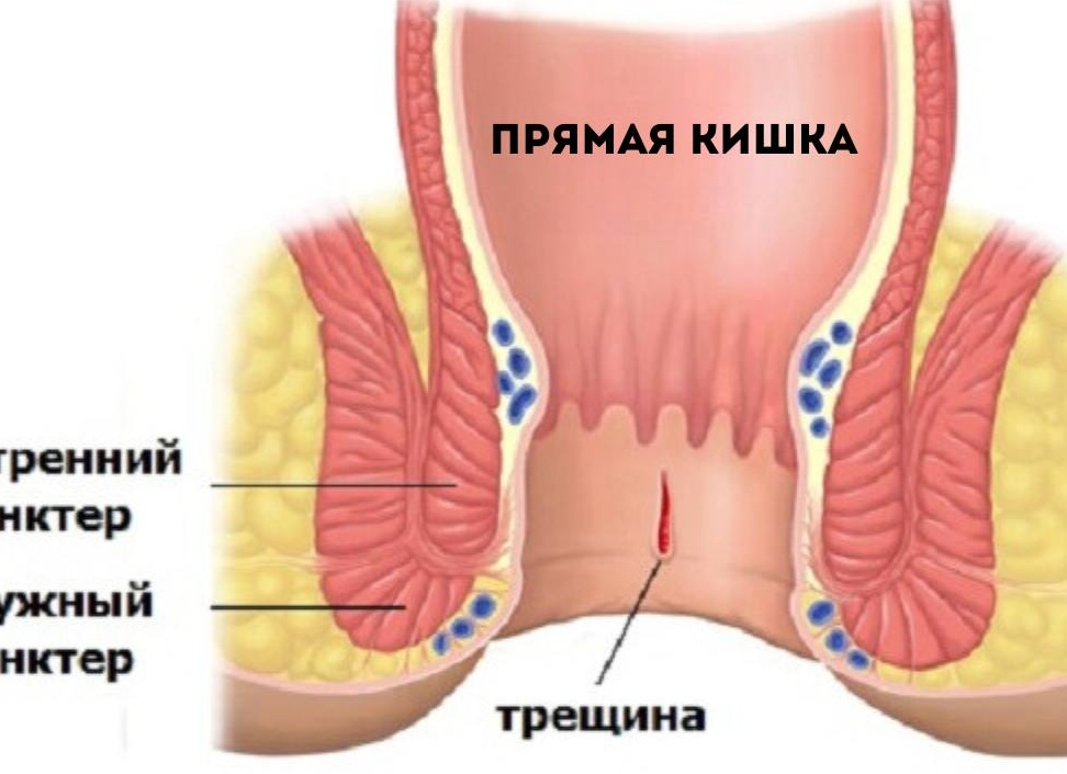 Причины и лечение сфинктерита