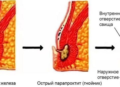 Парапроктит после удаления