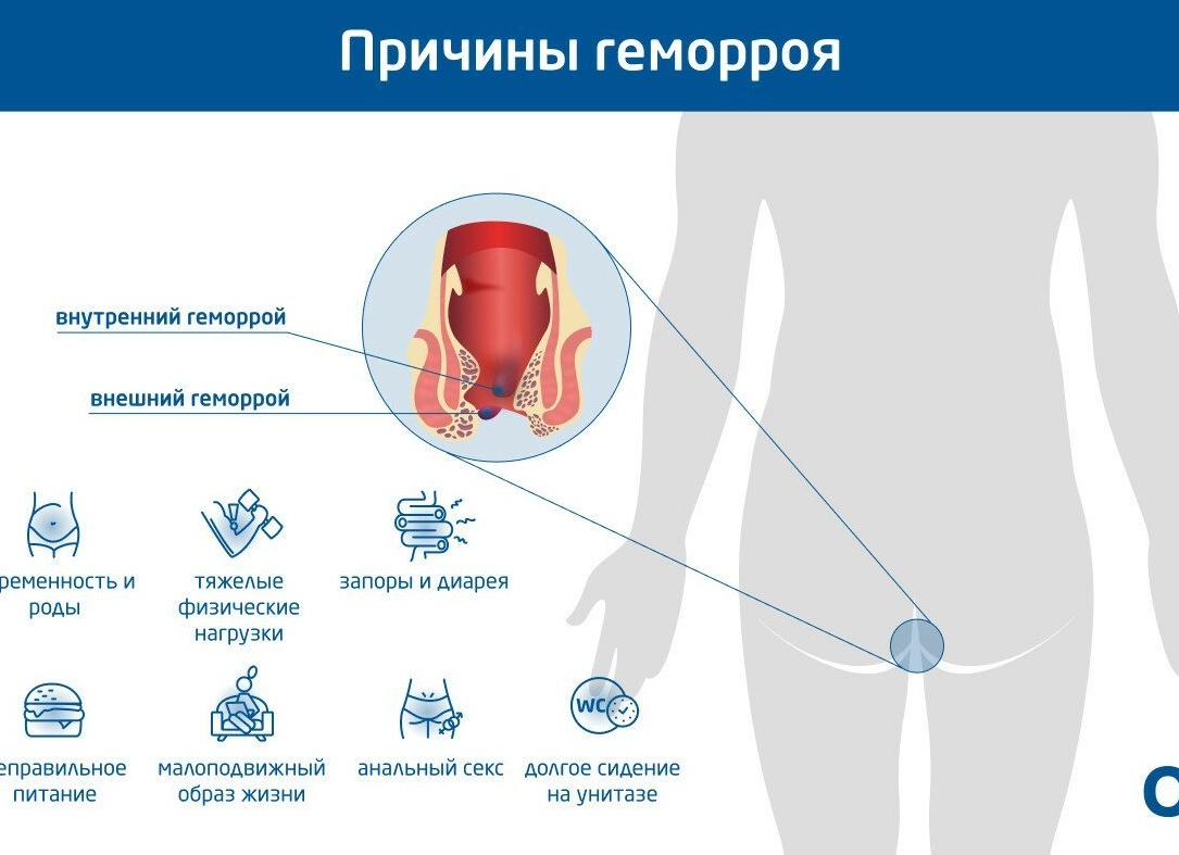 Блокада при геморрое Блокада при геморрое