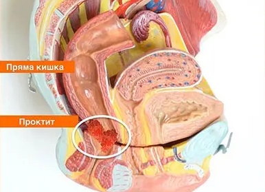 Проктит и антибиотики