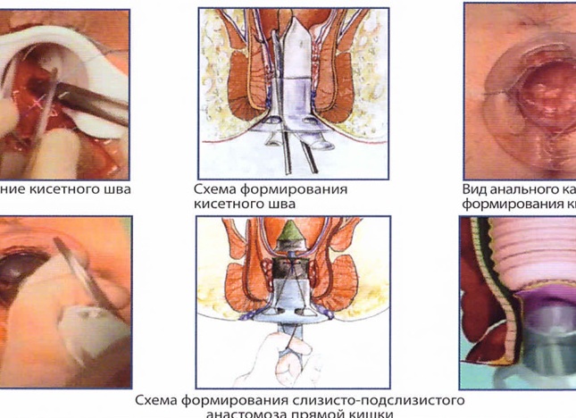 Удаление геморроя