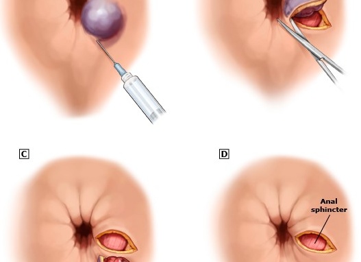 Воспаление геморроя