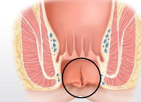Лечение трещин заднего прохода в домашних условиях