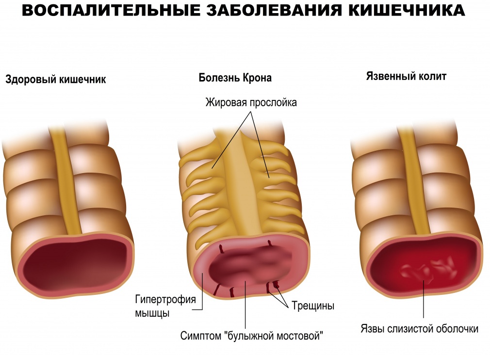 Кровь в стуле