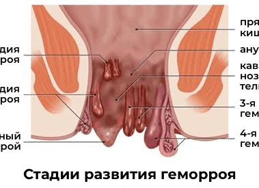 Симптомы и лечение наружного геморроя