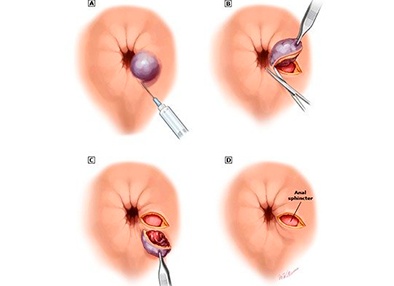 Тромбэктомия геморроя