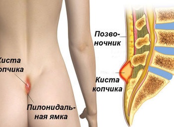 Что такое копчиковая киста?