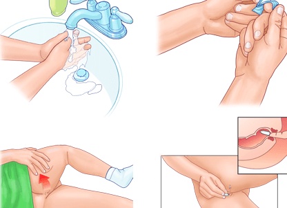 Как ставить свечи от геморроя?