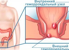 Консервативные методы лечения геморроя
