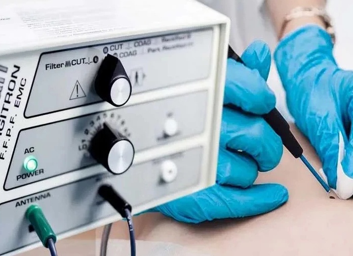 Радиоволновая терапия при геморрое