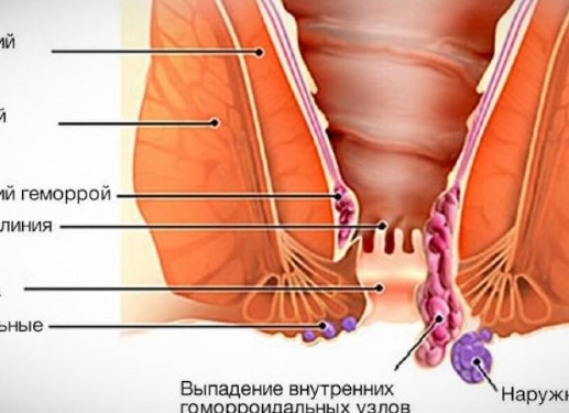 Причины и лечение геморроя у мужчин