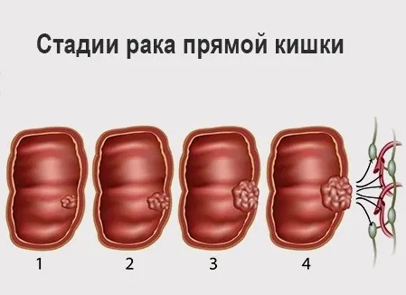 Как определить рак прямой кишки? Как определить рак прямой кишки?